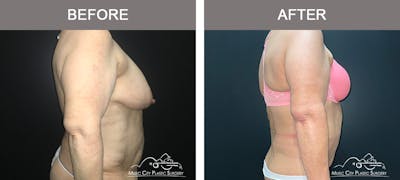 Body Lift Before & After Gallery - Patient 275064 - Image 3