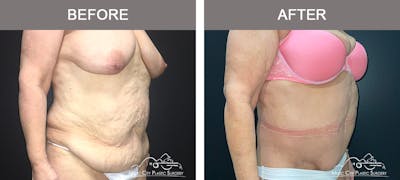Body Lift Before & After Gallery - Patient 275064 - Image 2