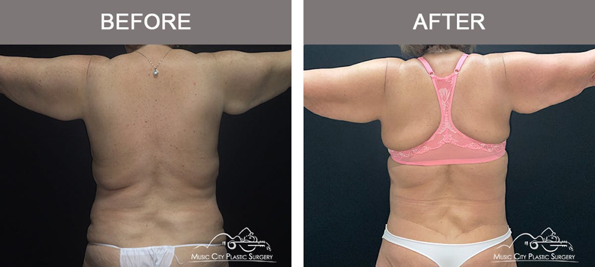 Body Lift Before & After Gallery - Patient 275064 - Image 6