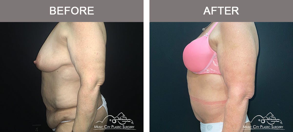 Body Lift Before & After Gallery - Patient 275064 - Image 5