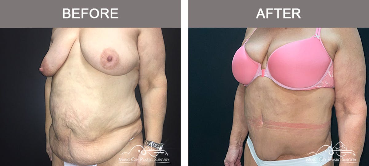 Body Lift Before & After Gallery - Patient 275064 - Image 4