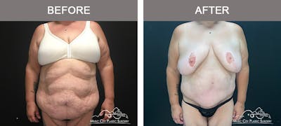 Body Lift Before & After Gallery - Patient 425509 - Image 1