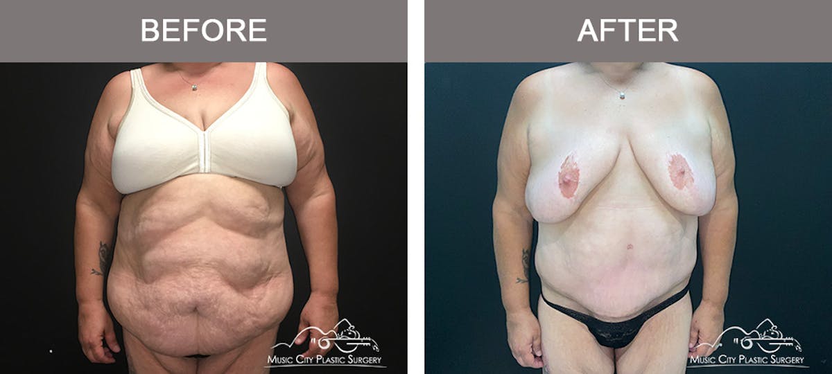Body Lift Before & After Gallery - Patient 425509 - Image 1