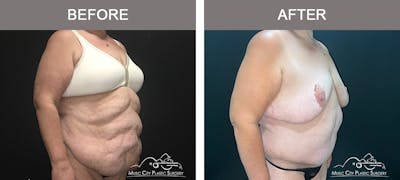 Body Lift Before & After Gallery - Patient 425509 - Image 2