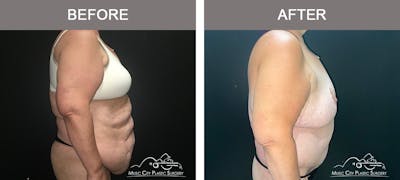 Body Lift Before & After Gallery - Patient 425509 - Image 3