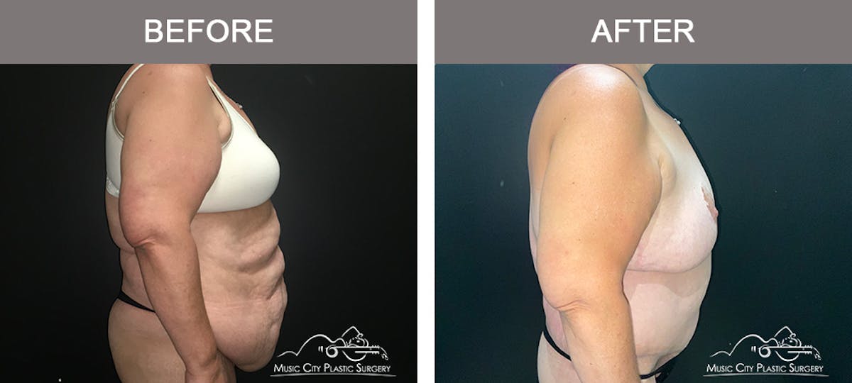Body Lift Before & After Gallery - Patient 425509 - Image 3