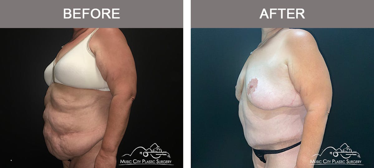 Body Lift Before & After Gallery - Patient 425509 - Image 4