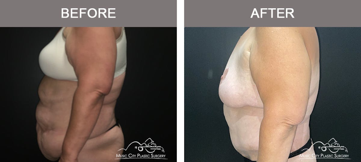Body Lift Before & After Gallery - Patient 425509 - Image 5