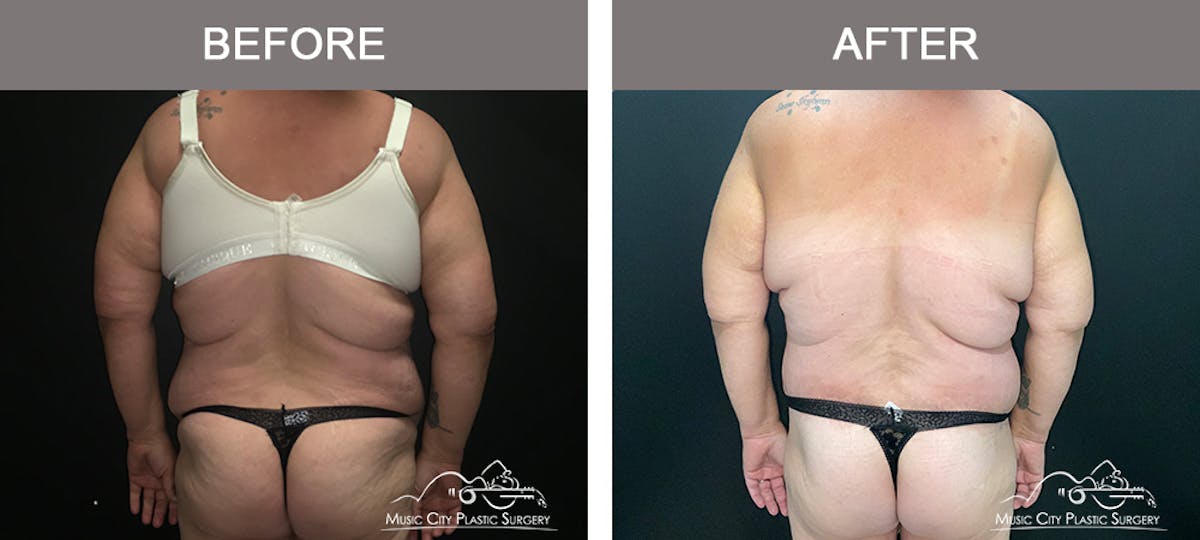 Body Lift Before & After Gallery - Patient 425509 - Image 6