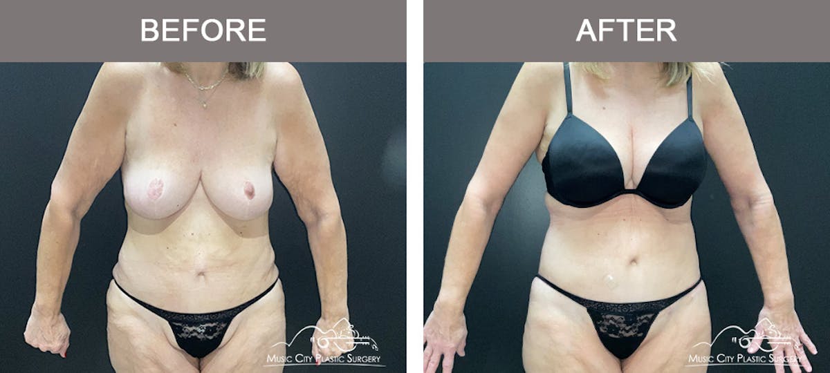 Body Lift Before & After Gallery - Patient 180805 - Image 1