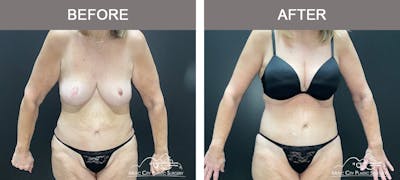 Body Lift Before & After Gallery - Patient 180805 - Image 1