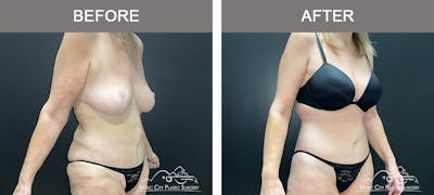 Body Lift Before & After Gallery - Patient 180805 - Image 2