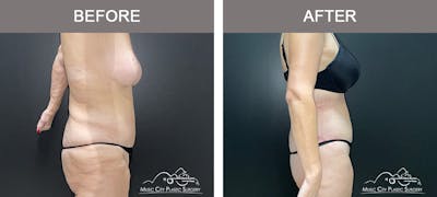 Body Lift Before & After Gallery - Patient 180805 - Image 3