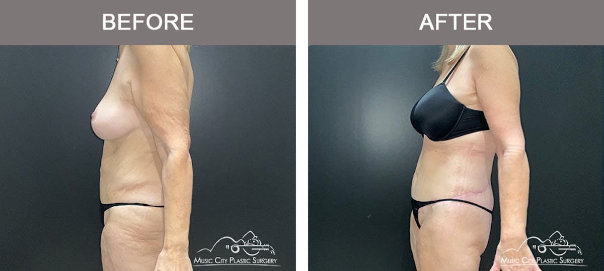 Body Lift Before & After Gallery - Patient 180805 - Image 4