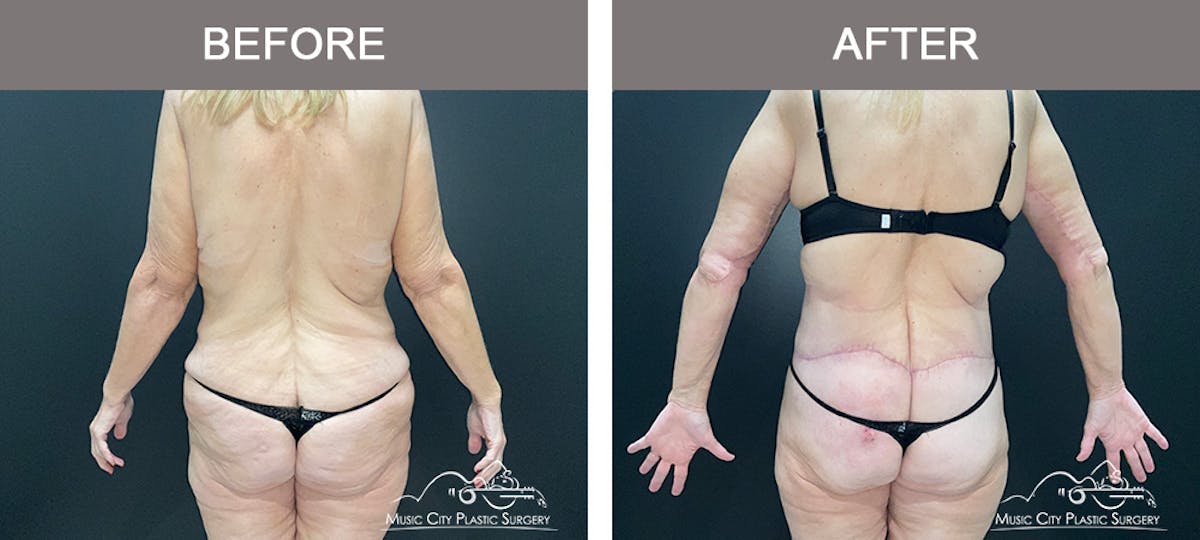 Body Lift Before & After Gallery - Patient 180805 - Image 5