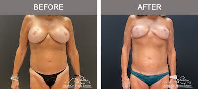 Body Lift Before & After Gallery - Patient 121821 - Image 1
