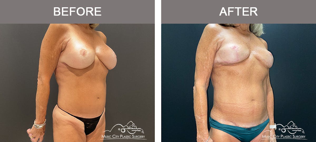 Body Lift Before & After Gallery - Patient 121821 - Image 2