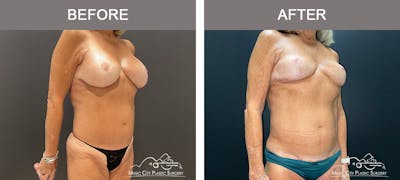 Body Lift Before & After Gallery - Patient 121821 - Image 2