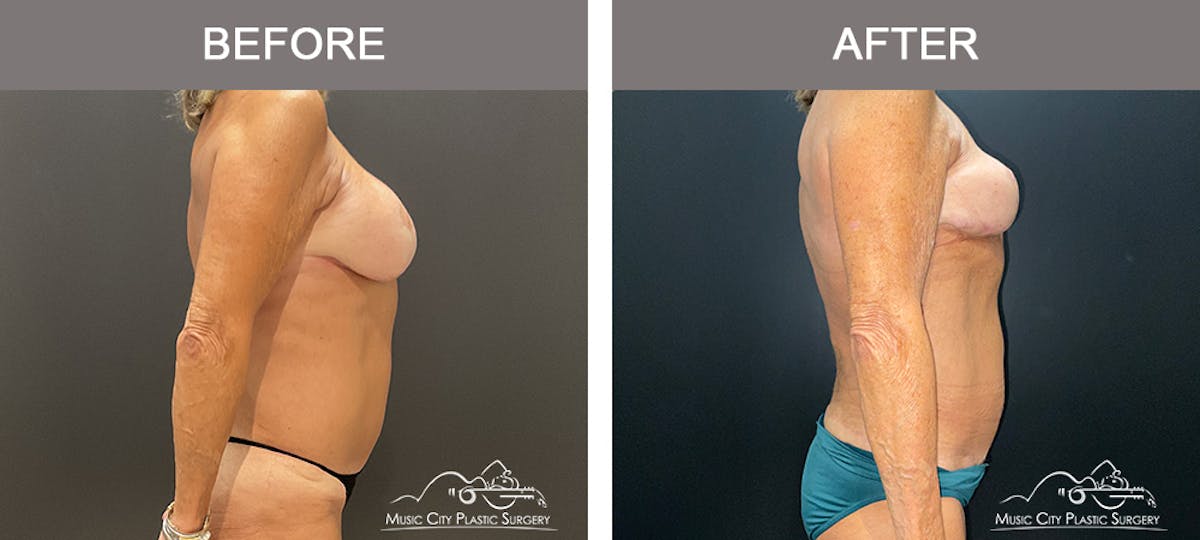 Body Lift Before & After Gallery - Patient 121821 - Image 3