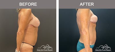 Body Lift Before & After Gallery - Patient 121821 - Image 3