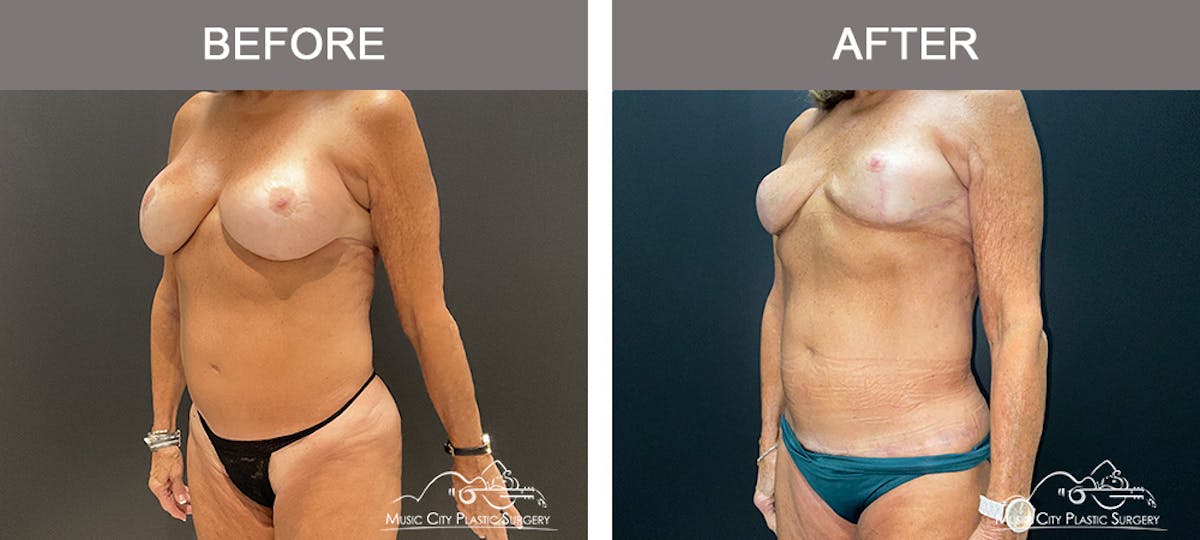 Body Lift Before & After Gallery - Patient 121821 - Image 4