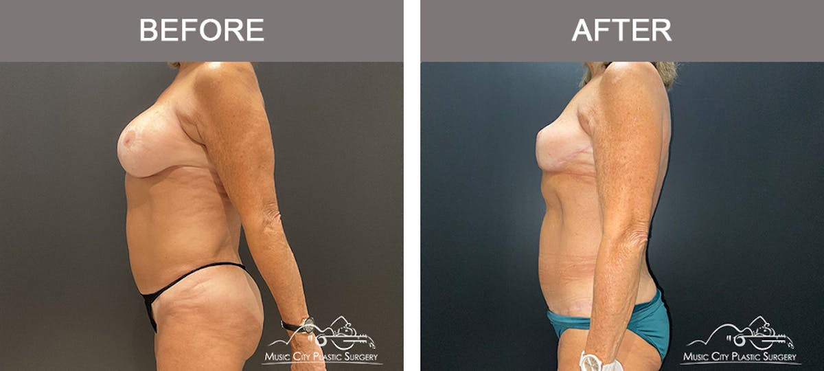 Body Lift Before & After Gallery - Patient 121821 - Image 5