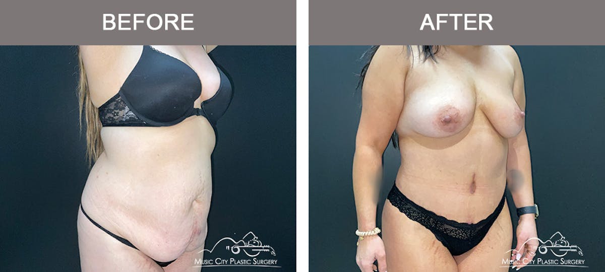 Body Lift Before & After Gallery - Patient 426788 - Image 1