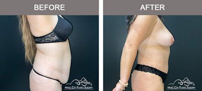 Body Lift Before & After Gallery - Patient 426788 - Image 2