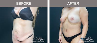 Body Lift Before & After Gallery - Patient 426788 - Image 3
