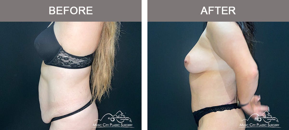Body Lift Before & After Gallery - Patient 426788 - Image 4