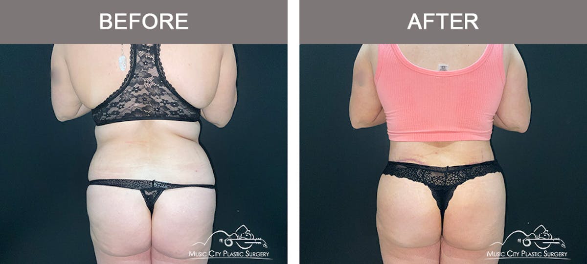 Body Lift Before & After Gallery - Patient 426788 - Image 5