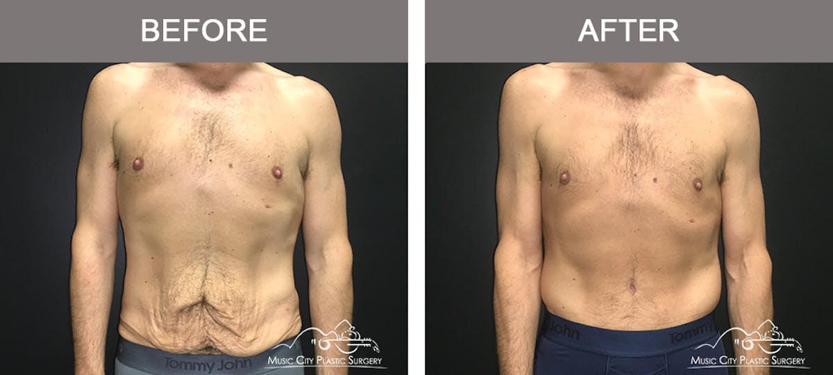 BodyLift Before & After Gallery - Patient 310951 - Image 1