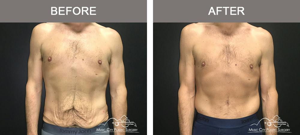 Male BodyLift Before & After Gallery - Patient 310951 - Image 1