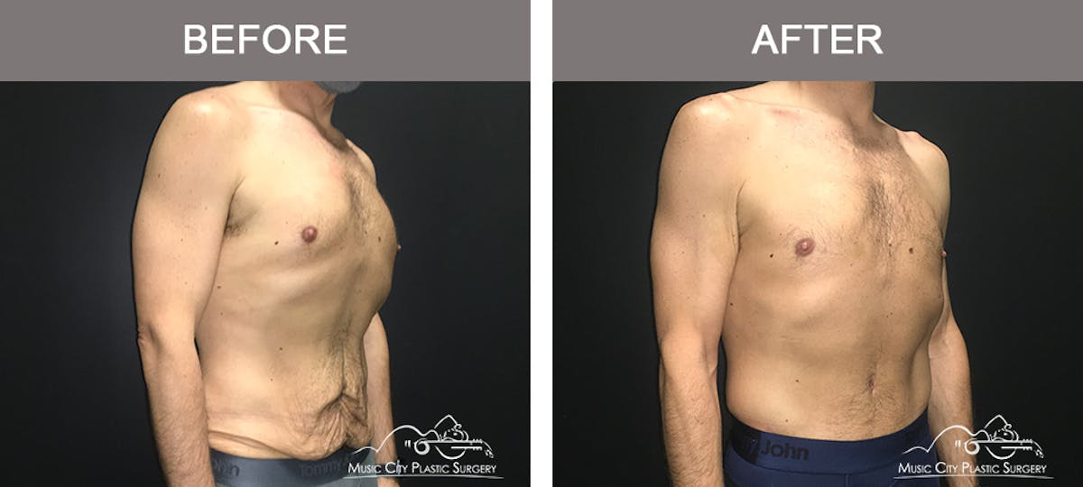 BodyLift Before & After Gallery - Patient 310951 - Image 2