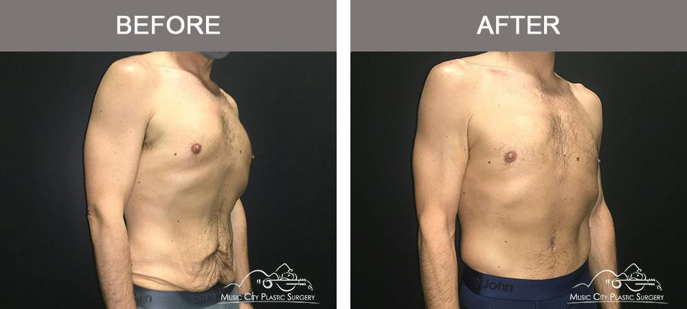 Male BodyLift Before & After Gallery - Patient 310951 - Image 2