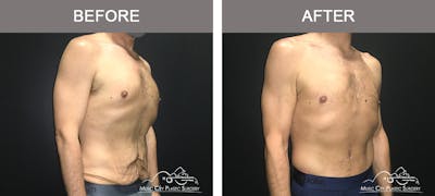 BodyLift Before & After Gallery - Patient 310951 - Image 2