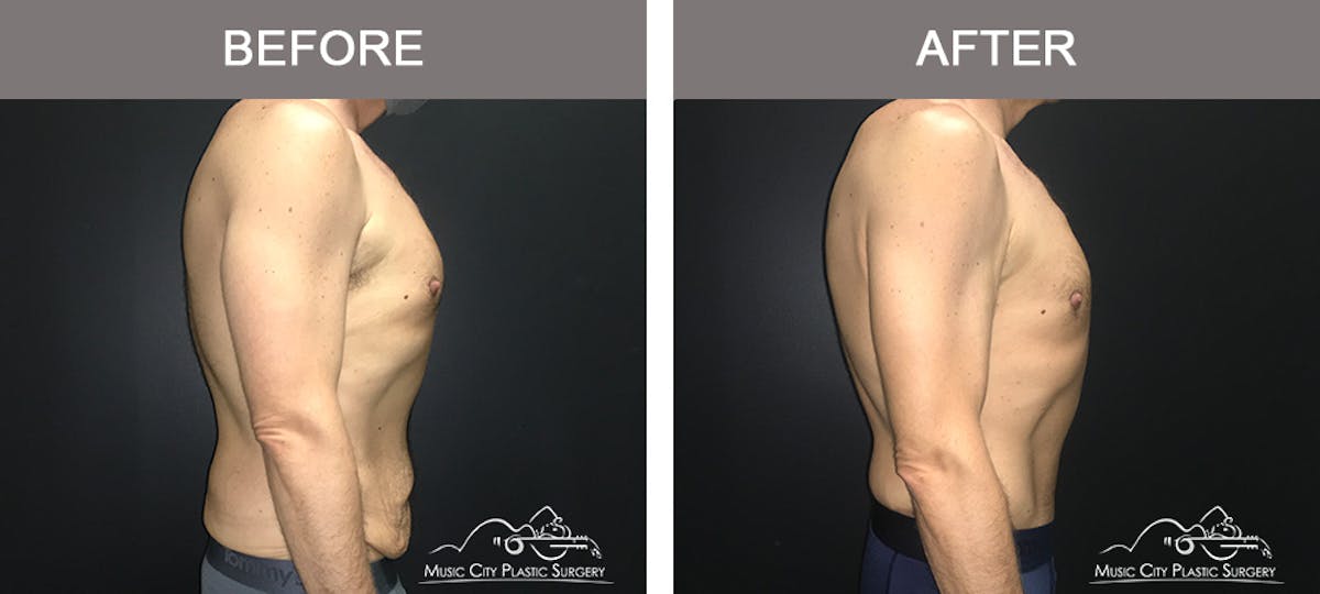 BodyLift Before & After Gallery - Patient 310951 - Image 3