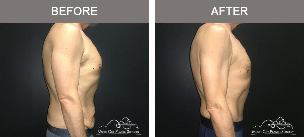 Male BodyLift Before & After Gallery - Patient 310951 - Image 3