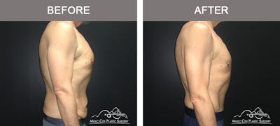 BodyLift Before & After Gallery - Patient 310951 - Image 3