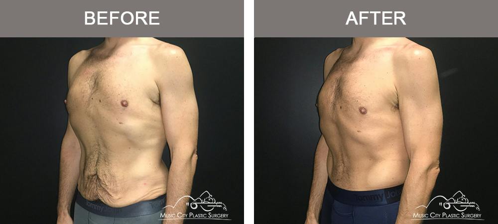 Male BodyLift Before & After Gallery - Patient 310951 - Image 4