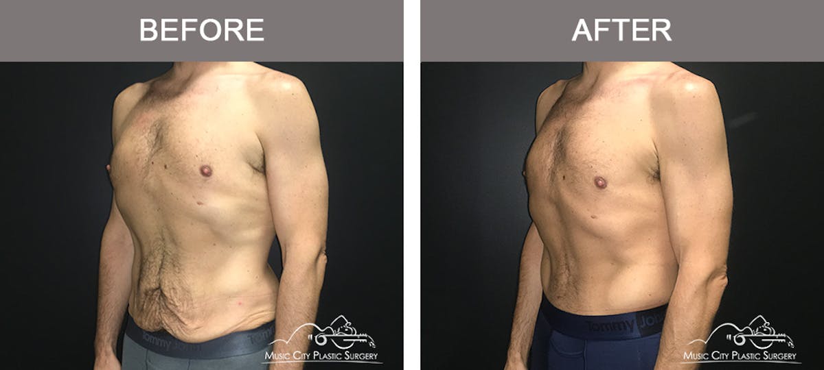 BodyLift Before & After Gallery - Patient 310951 - Image 4