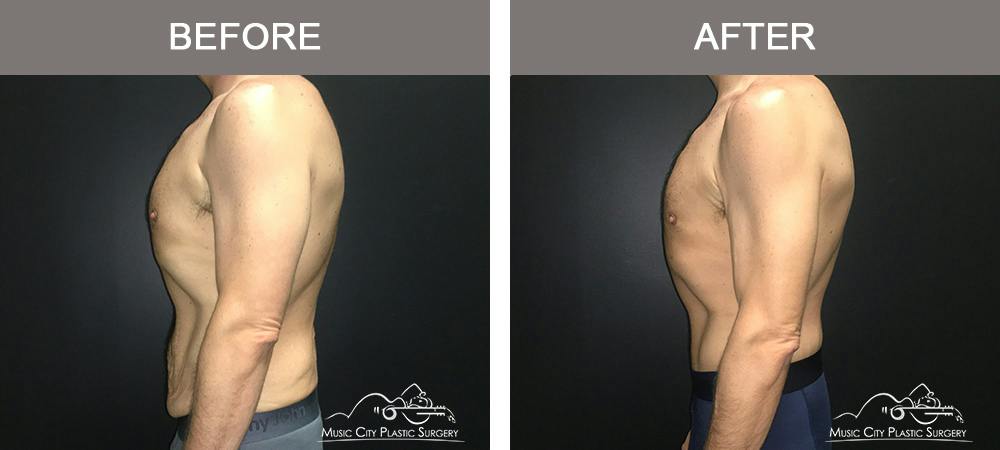 Male BodyLift Before & After Gallery - Patient 310951 - Image 5
