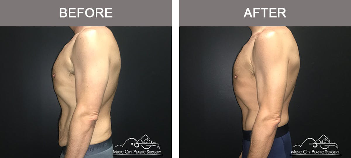 BodyLift Before & After Gallery - Patient 310951 - Image 5