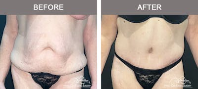 Body Lift Before & After Gallery - Patient 394645 - Image 1