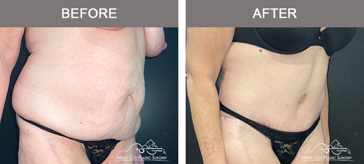 Body Lift Before & After Gallery - Patient 394645 - Image 2