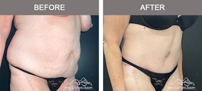 Body Lift Before & After Gallery - Patient 394645 - Image 2