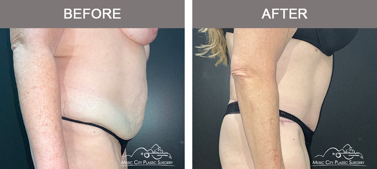 Body Lift Before & After Gallery - Patient 394645 - Image 3