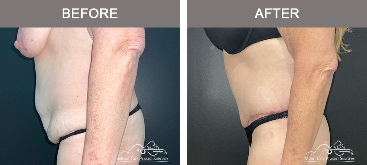 Body Lift Before & After Gallery - Patient 394645 - Image 4