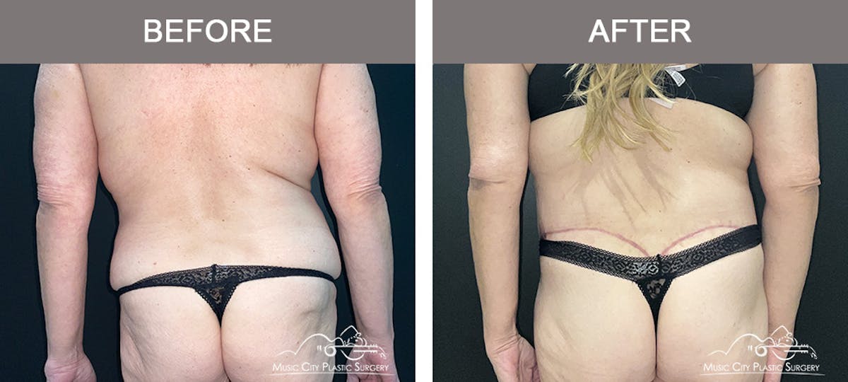 Body Lift Before & After Gallery - Patient 394645 - Image 5
