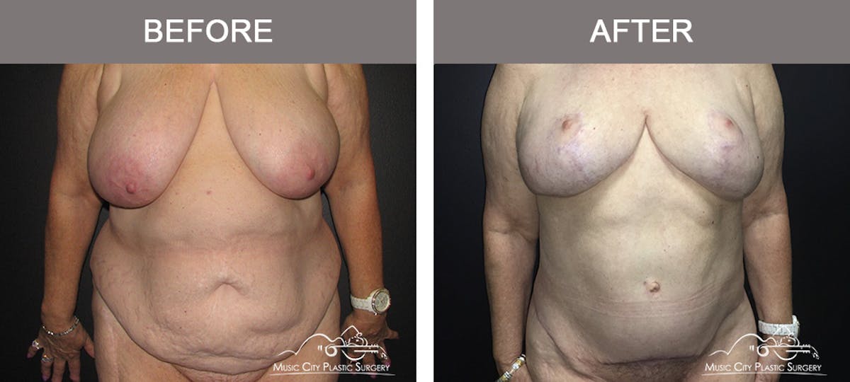 Body Lift Before & After Gallery - Patient 153381 - Image 1